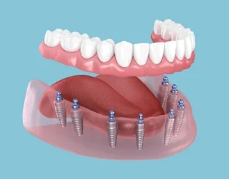All Teeth Implants at Mehta Dental Clinic in Naranpura