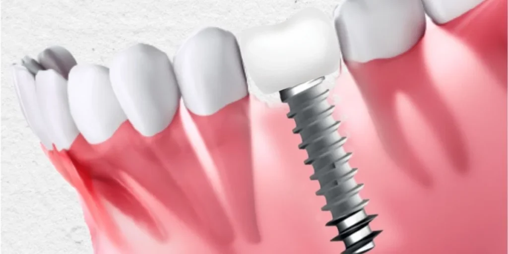 Basal Dental Implant at Mehta Dental Clinic in naranpura
