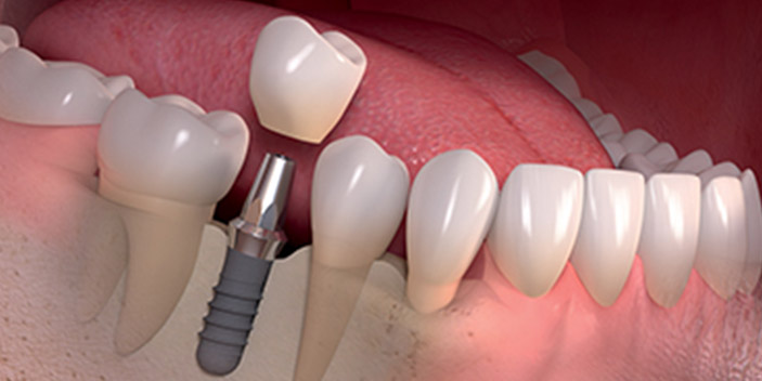 Immediate Dental Implant at Mehta Dental Clinic in Naranoura