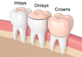 Inlay & Onlay at Mehta Dental Clinic in Naranpura