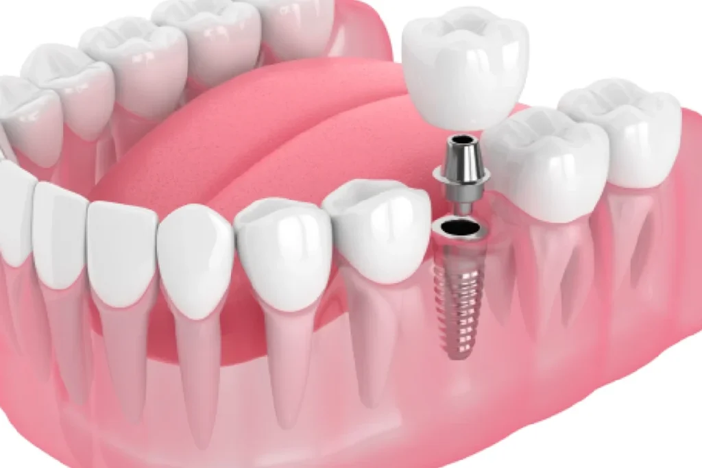 Single Tooth Implant at Mehta Dental Clinic in Naranpura Ahmedabad